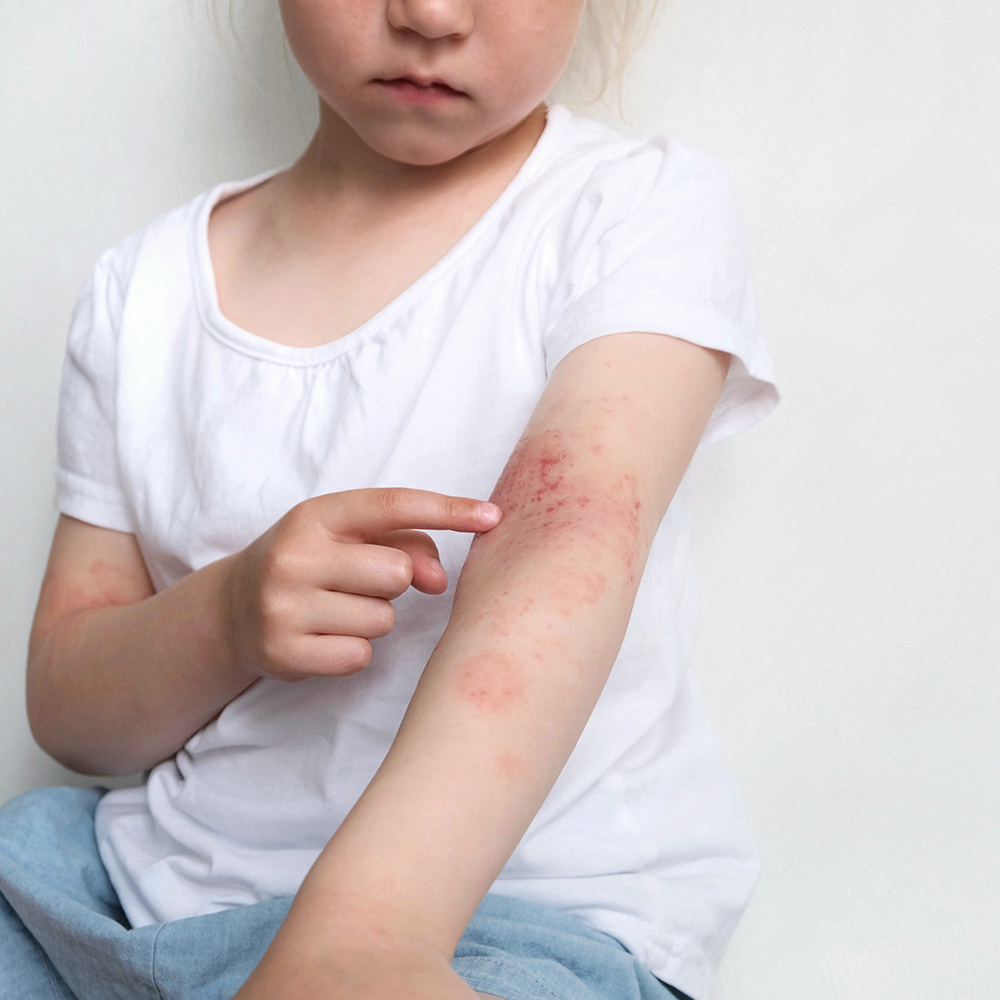 Managing Children and Adults With Moderate-to-Severe Atopic Dermatitis: Addressing Treatment Challenges and Improving Access to Care in Rural and Underserved Communities