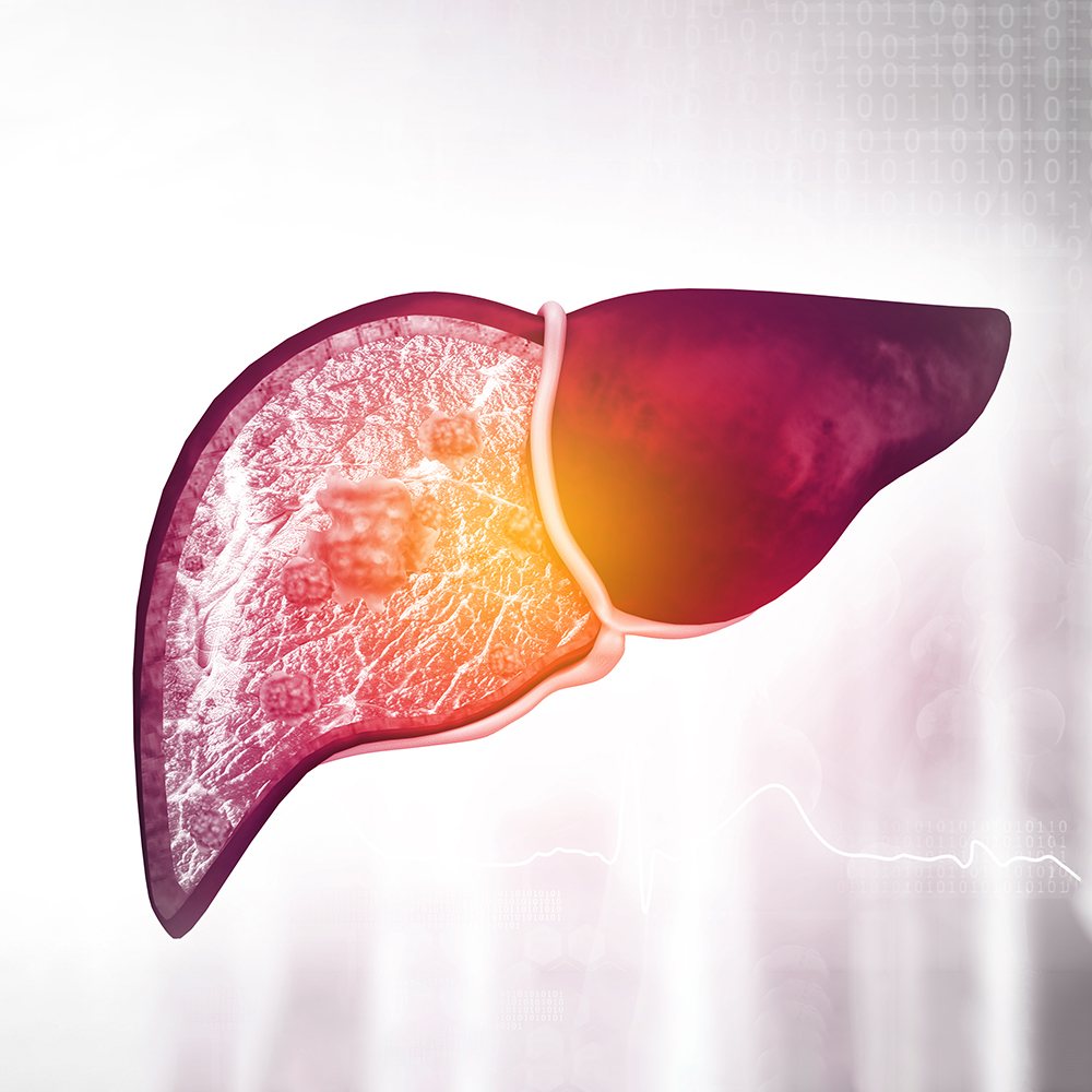 Overcoming Barriers to Equitable Care in Hepatocellular Carcinoma: Integrating New Evidence Into Clinical Practice