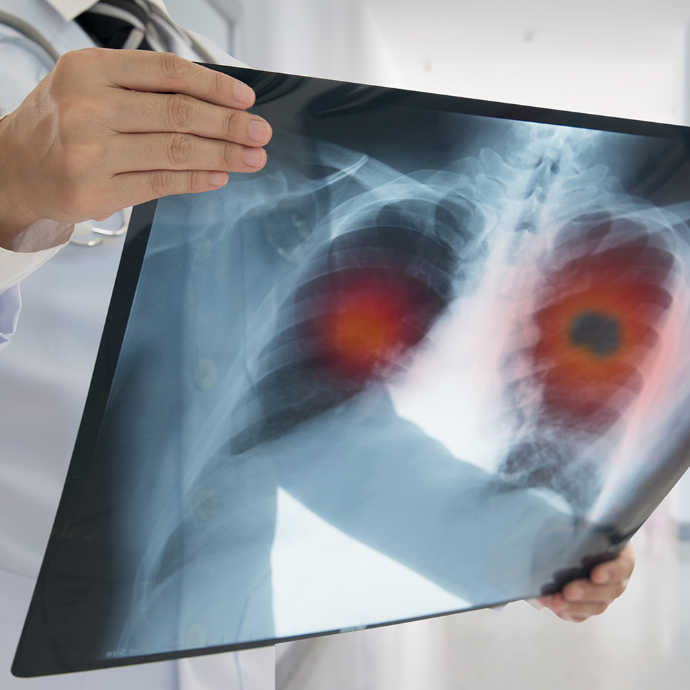 Integrating the Latest Evidence on Immune Checkpoint Inhibitors Into the Management of Advanced Non-Small Cell Lung Cancer