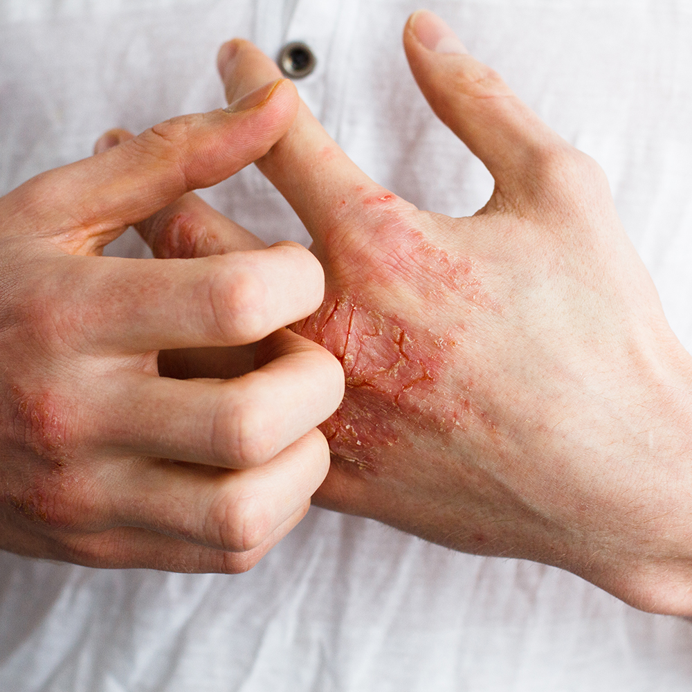 Addressing the Burden of Atopic Dermatitis in Children and Adults: Strategies for Improving Care and Outcomes in Rural and Underserved Communities