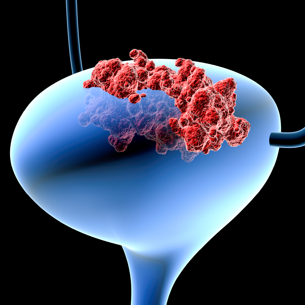 Evolving Treatment Options in First-Line Metastatic Urothelial Carcinoma: Integrating the Latest Guidance and Evidence in Rural and Underserved Communities