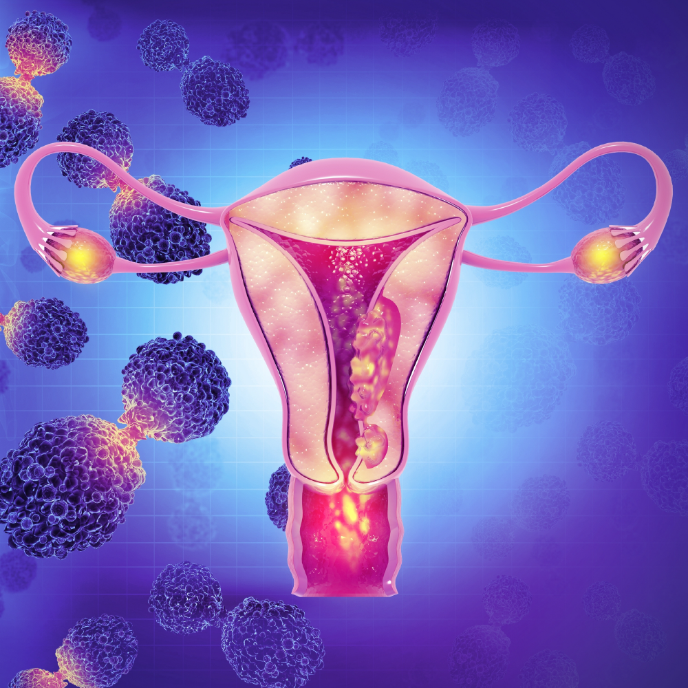 Improving Equity in Endometrial Cancer Care and Treatment: Accelerating Change to Improve Patient Outcomes in Rural and Underserved Communities