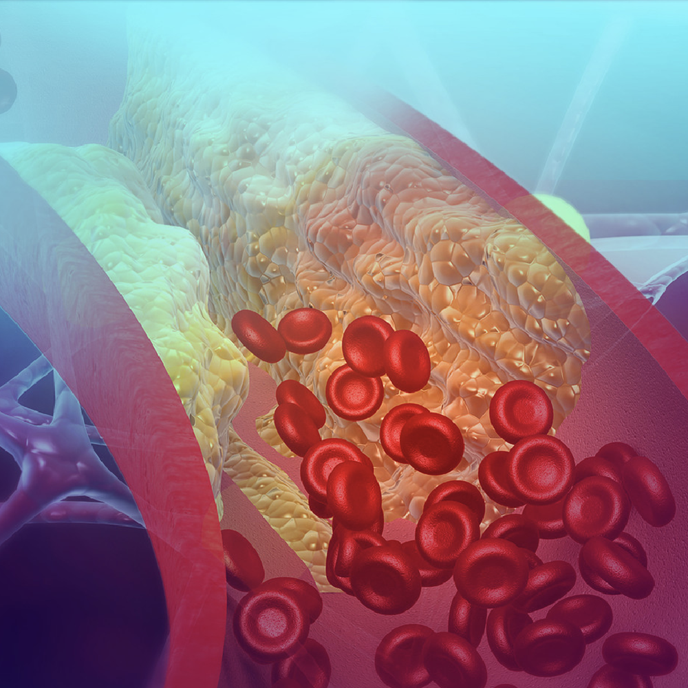 Improving Identification and Management of Hyperlipidemia in Rural and Underserved Communities