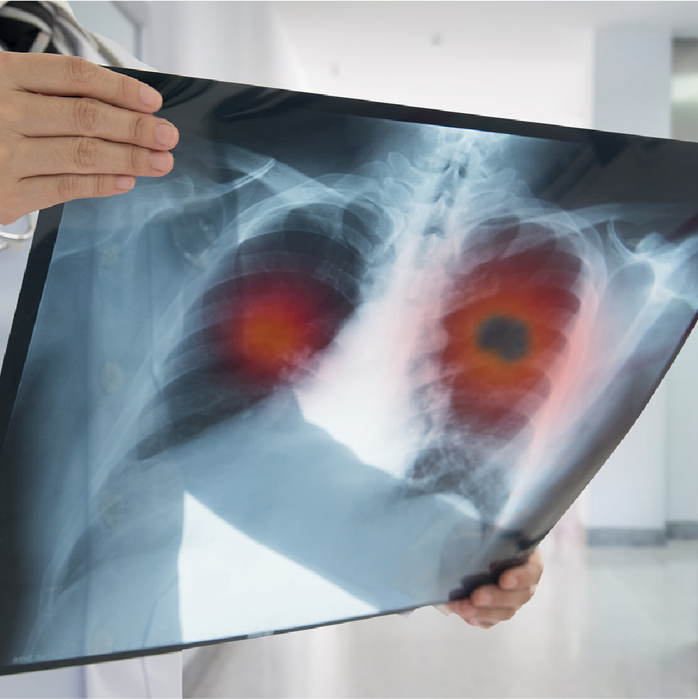 Enhancing Oncology Nursing Care in Advanced NSCLC: Bridging Gaps in Rural and Underserved Communities